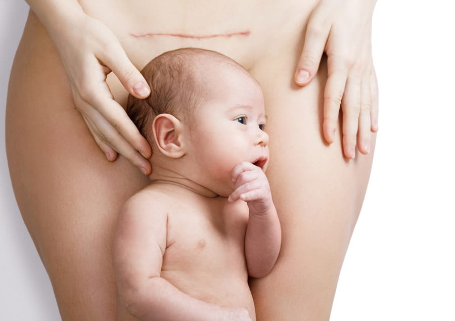 Ins en outs van een keizersnee!